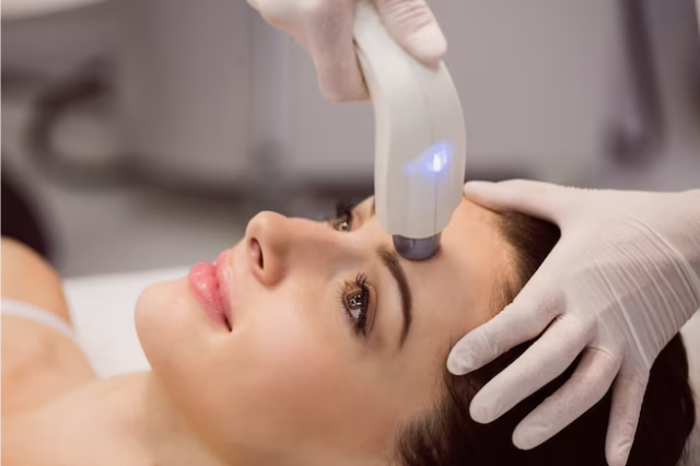laser skin tightening
